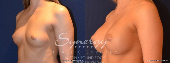 Before & After Breast Augmentation Case 435 View #2 View in Austin, TX