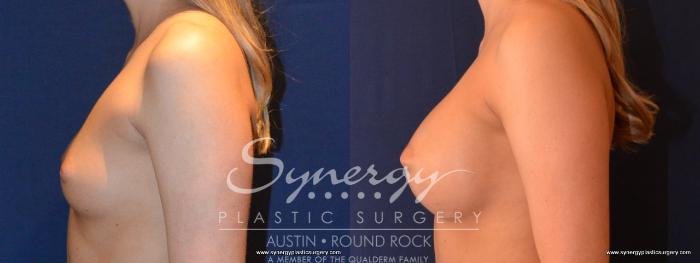 Before & After Breast Augmentation Case 435 View #3 View in Austin, TX
