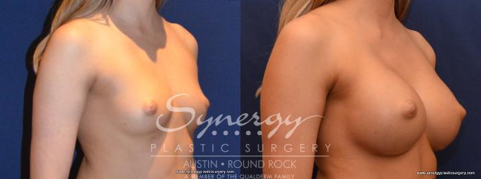 Before & After Breast Augmentation Case 435 View #4 View in Austin, TX