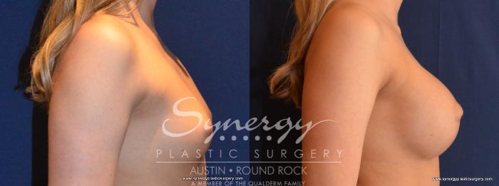 Before & After Breast Augmentation Case 435 View #5 View in Austin, TX