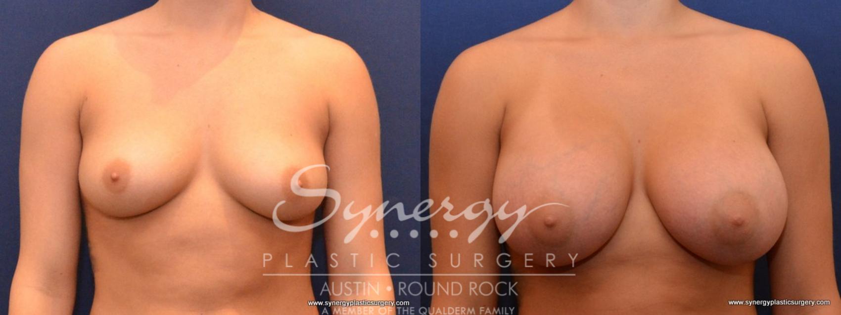 Before & After Breast Augmentation Case 436 View #1 View in Austin, TX