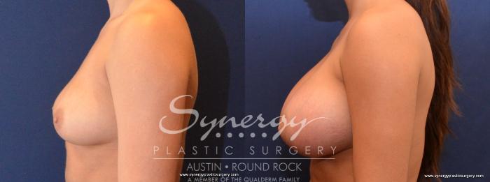 Before & After Breast Augmentation Case 436 View #2 View in Austin, TX