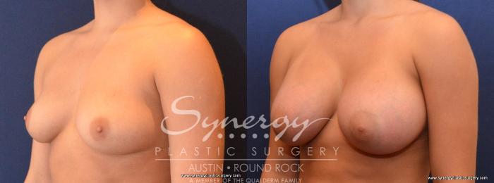 Before & After Breast Augmentation Case 436 View #3 View in Austin, TX