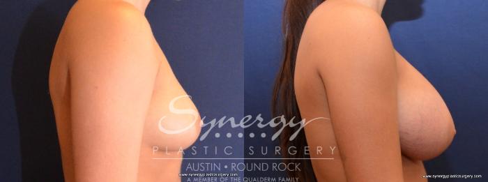 Before & After Breast Augmentation Case 436 View #4 View in Austin, TX
