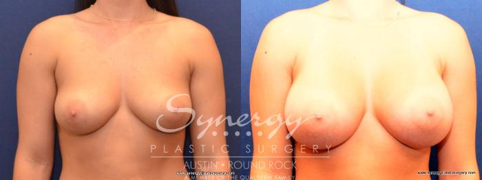 Before & After Breast Augmentation Case 437 View #1 View in Austin, TX
