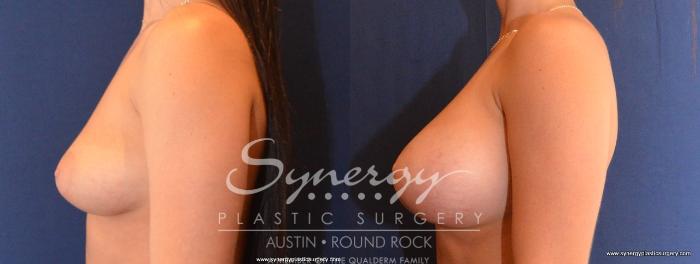 Before & After Breast Augmentation Case 437 View #2 View in Austin, TX