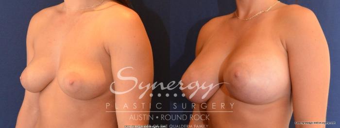 Before & After Breast Augmentation Case 437 View #3 View in Austin, TX