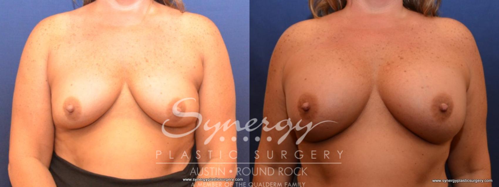 Before & After Breast Augmentation Case 439 View #1 View in Austin, TX