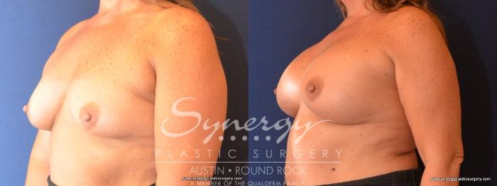 Before & After Breast Augmentation Case 439 View #3 View in Austin, TX
