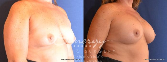 Before & After Breast Augmentation Case 439 View #4 View in Austin, TX