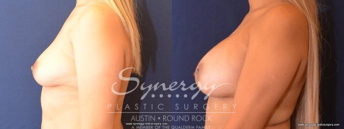 Before & After Breast Augmentation Case 441 View #2 View in Austin, TX