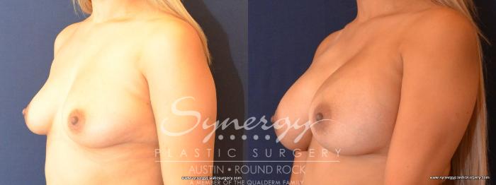 Before & After Breast Augmentation Case 441 View #3 View in Austin, TX