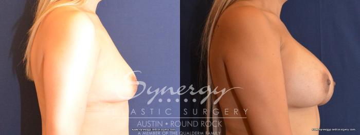 Before & After Breast Augmentation Case 441 View #4 View in Austin, TX
