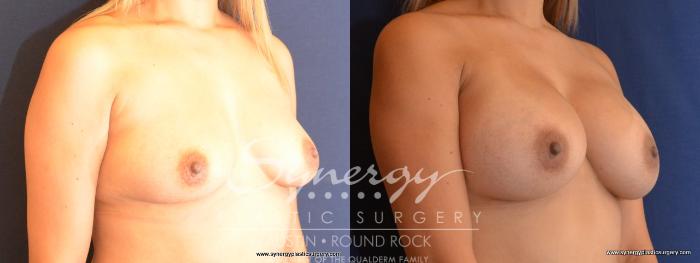 Before & After Breast Augmentation Case 441 View #5 View in Austin, TX