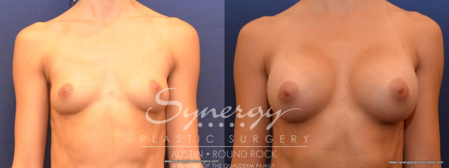 Before & After Breast Augmentation Case 442 View #1 View in Austin, TX