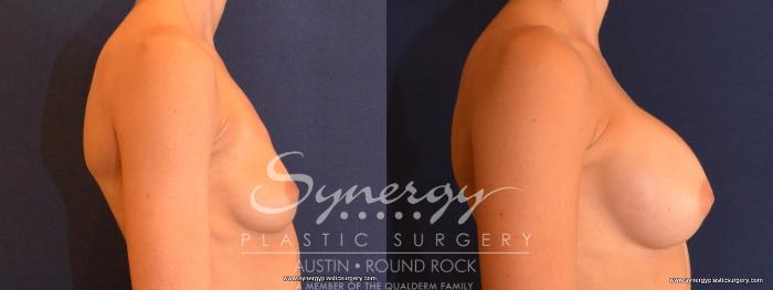 Before & After Breast Augmentation Case 442 View #2 View in Austin, TX