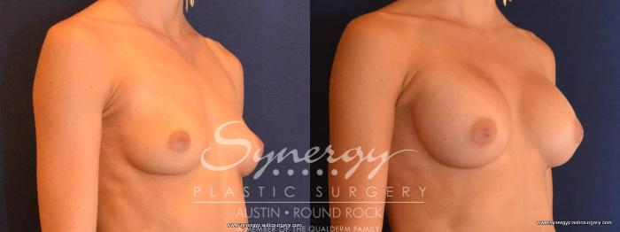 Before & After Breast Augmentation Case 442 View #3 View in Austin, TX