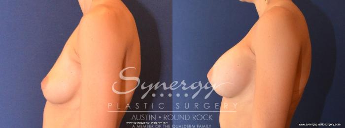 Before & After Breast Augmentation Case 442 View #4 View in Austin, TX