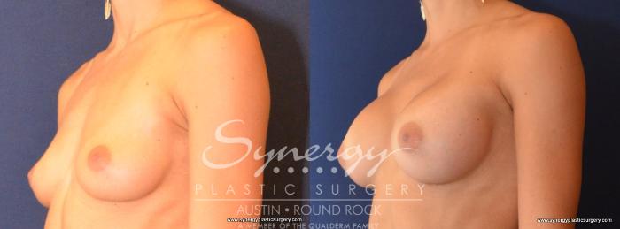 Before & After Breast Augmentation Case 442 View #5 View in Austin, TX