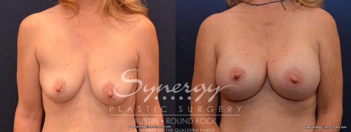 Before & After Breast Augmentation Case 443 View #1 View in Austin, TX