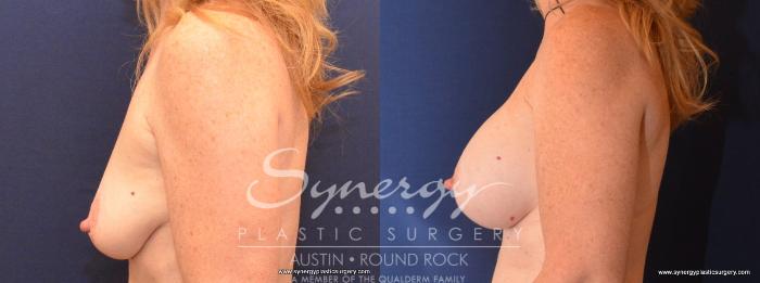 Before & After Breast Augmentation Case 443 View #3 View in Austin, TX