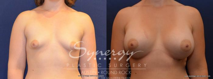 Before & After Breast Augmentation Case 444 View #1 View in Austin, TX