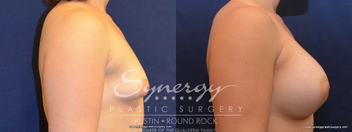 Before & After Breast Augmentation Case 444 View #2 View in Austin, TX