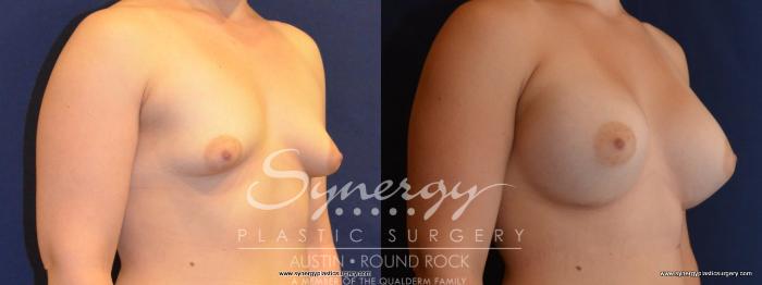Before & After Breast Augmentation Case 444 View #3 View in Austin, TX