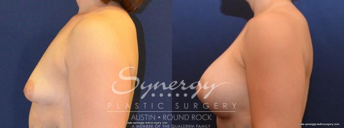 Before & After Breast Augmentation Case 444 View #4 View in Austin, TX