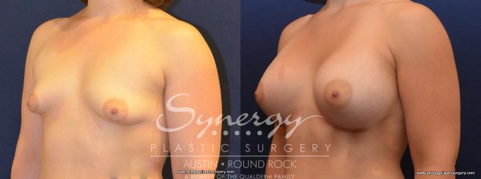 Before & After Breast Augmentation Case 444 View #5 View in Austin, TX