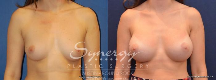 Before & After Breast Augmentation Case 448 View #1 View in Austin, TX
