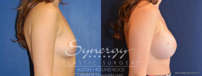 Before & After Breast Augmentation Case 448 View #4 View in Austin, TX