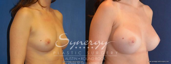 Before & After Breast Augmentation Case 448 View #5 View in Austin, TX