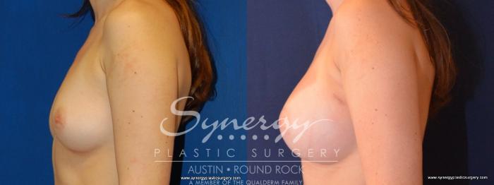 Before & After Breast Augmentation Case 448 View #6 View in Austin, TX
