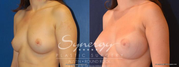 Before & After Breast Augmentation Case 448 View #7 View in Austin, TX