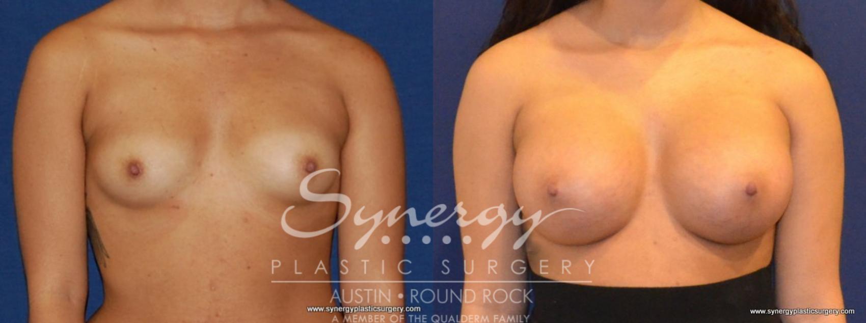 Before & After Breast Augmentation Case 449 View #1 View in Austin, TX