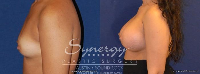 Before & After Breast Augmentation Case 449 View #2 View in Austin, TX