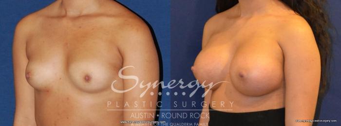 Before & After Breast Augmentation Case 449 View #3 View in Austin, TX
