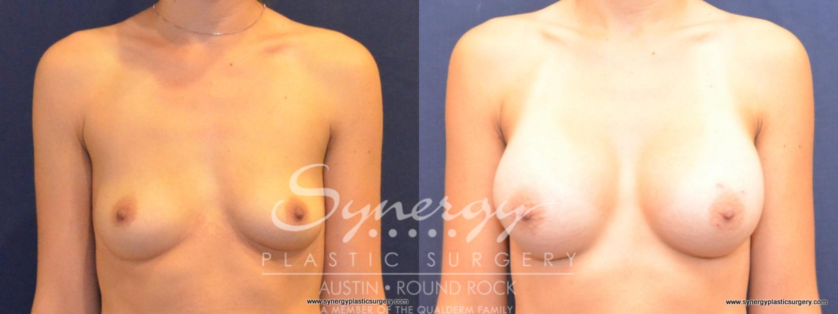Before & After Breast Augmentation Case 450 View #1 View in Austin, TX