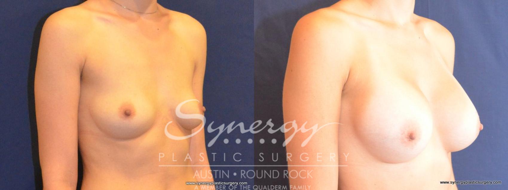 Before & After Breast Augmentation Case 450 View #3 View in Round Rock, TX