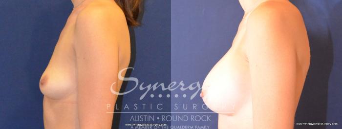 Before & After Breast Augmentation Case 450 View #4 View in Austin, TX