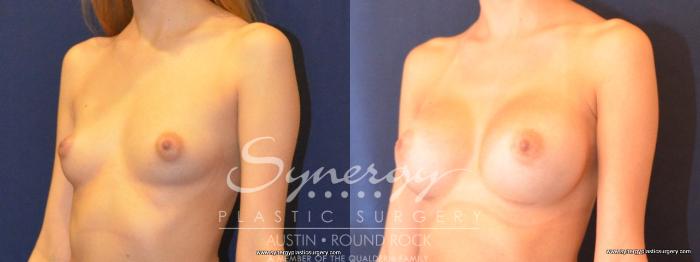 Before & After Breast Augmentation Case 452 View #3 View in Austin, TX