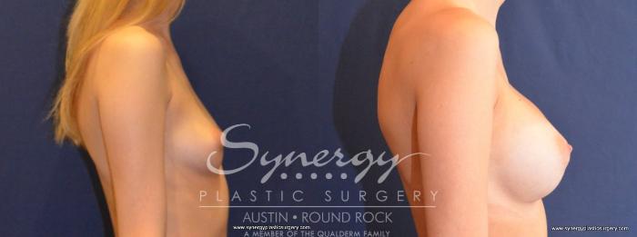 Before & After Breast Augmentation Case 452 View #4 View in Austin, TX