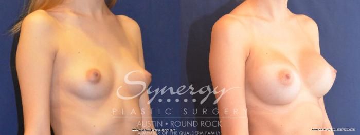 Before & After Breast Augmentation Case 452 View #5 View in Austin, TX