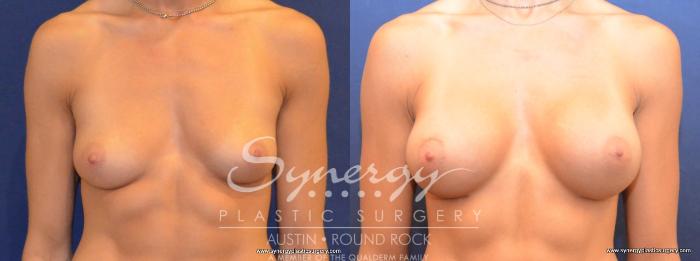 Before & After Breast Augmentation Case 453 View #1 View in Austin, TX