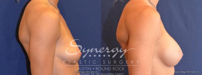 Before & After Breast Augmentation Case 453 View #2 View in Austin, TX
