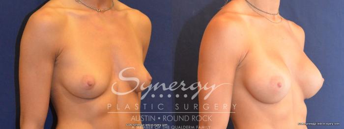 Before & After Breast Augmentation Case 453 View #3 View in Austin, TX