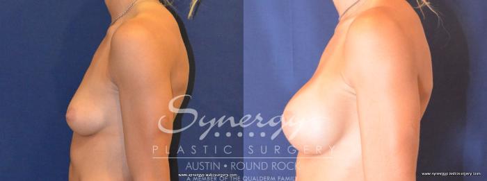 Before & After Breast Augmentation Case 453 View #4 View in Austin, TX