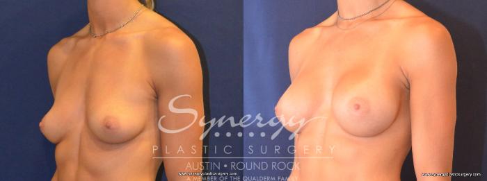 Before & After Breast Augmentation Case 453 View #5 View in Austin, TX