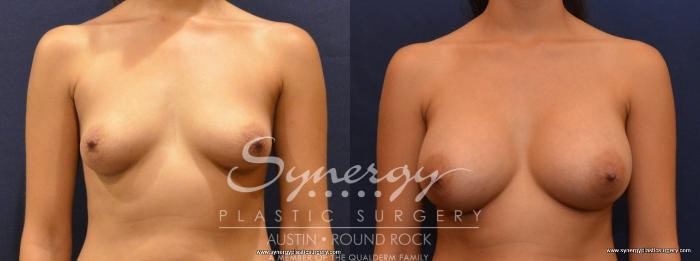 Before & After Breast Augmentation Case 457 View #1 View in Austin, TX